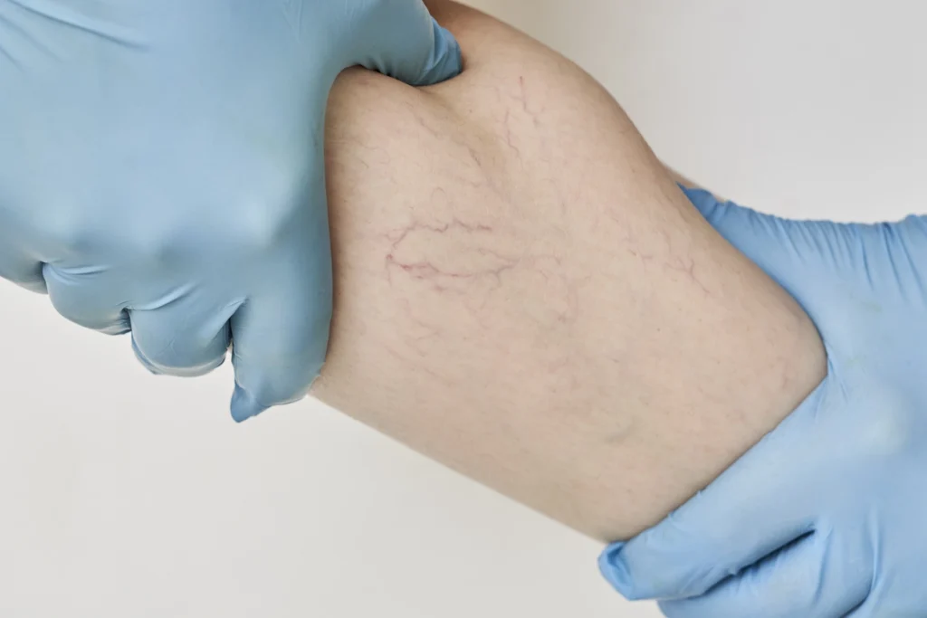 Veins in arm
